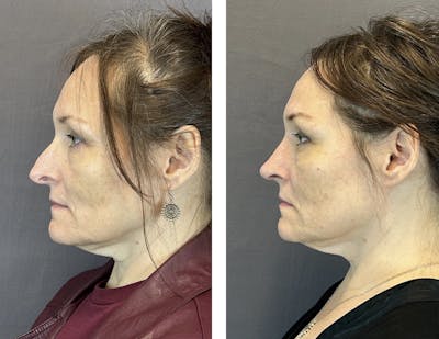 Rhinoplasty Before & After Gallery - Patient 152705029 - Image 4