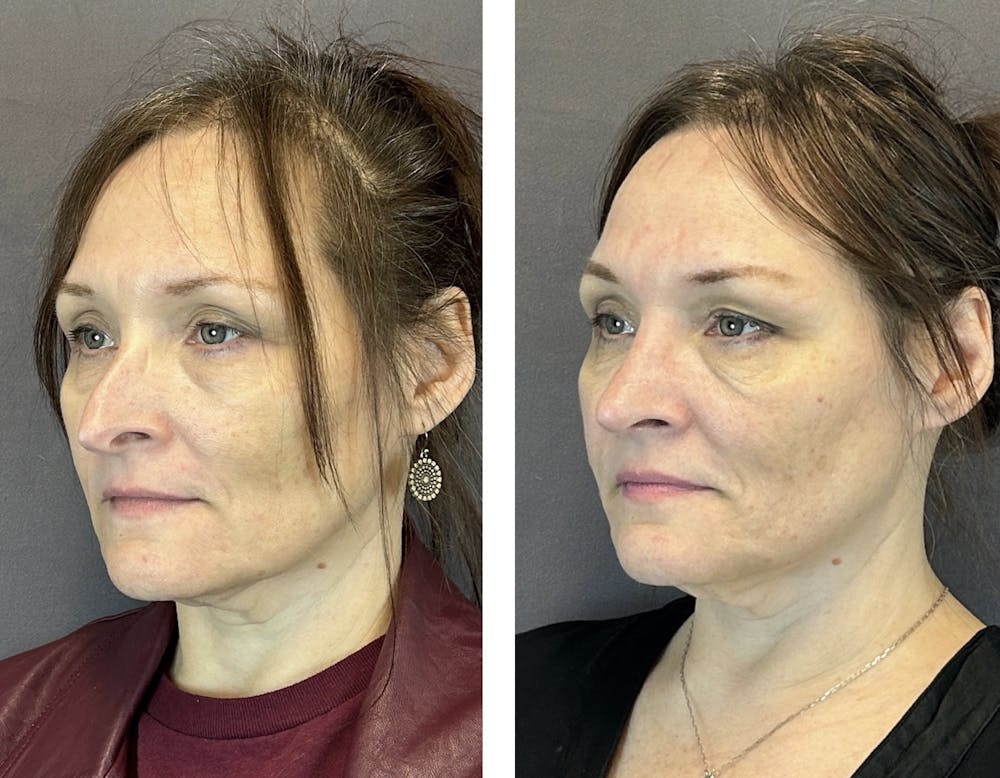 Rhinoplasty Before & After Gallery - Patient 152705029 - Image 5