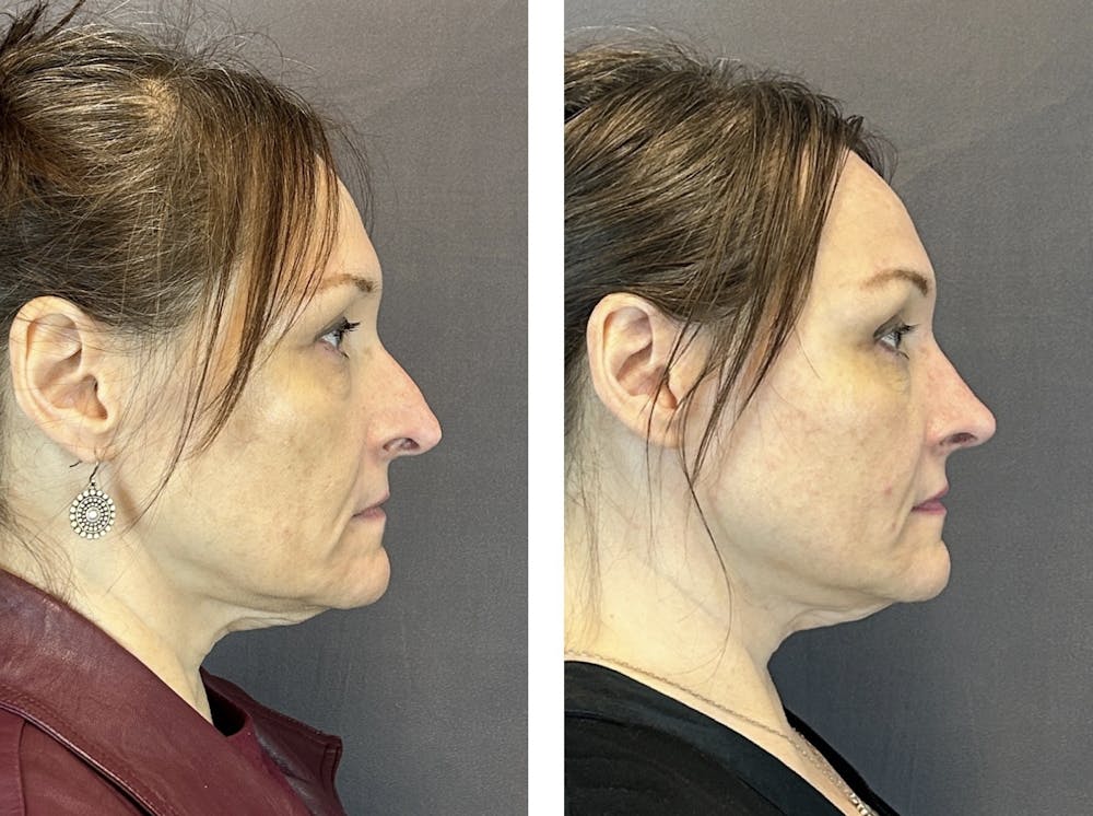 Rhinoplasty Before & After Gallery - Patient 152705029 - Image 1