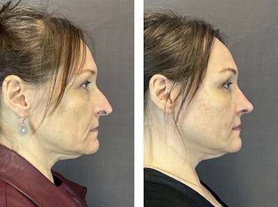 Rhinoplasty Before & After Gallery - Patient 152705029 - Image 1
