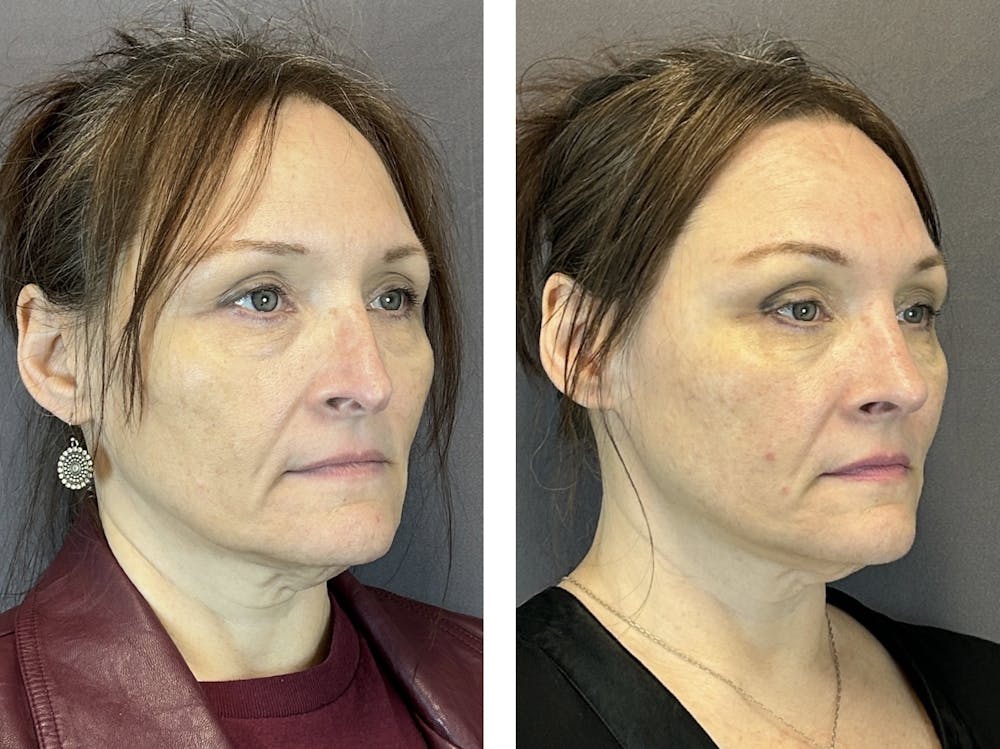 Rhinoplasty Before & After Gallery - Patient 152705029 - Image 2