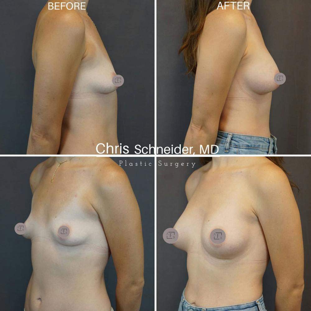 Breast Augmentation Before & After Gallery - Patient 160784298 - Image 1