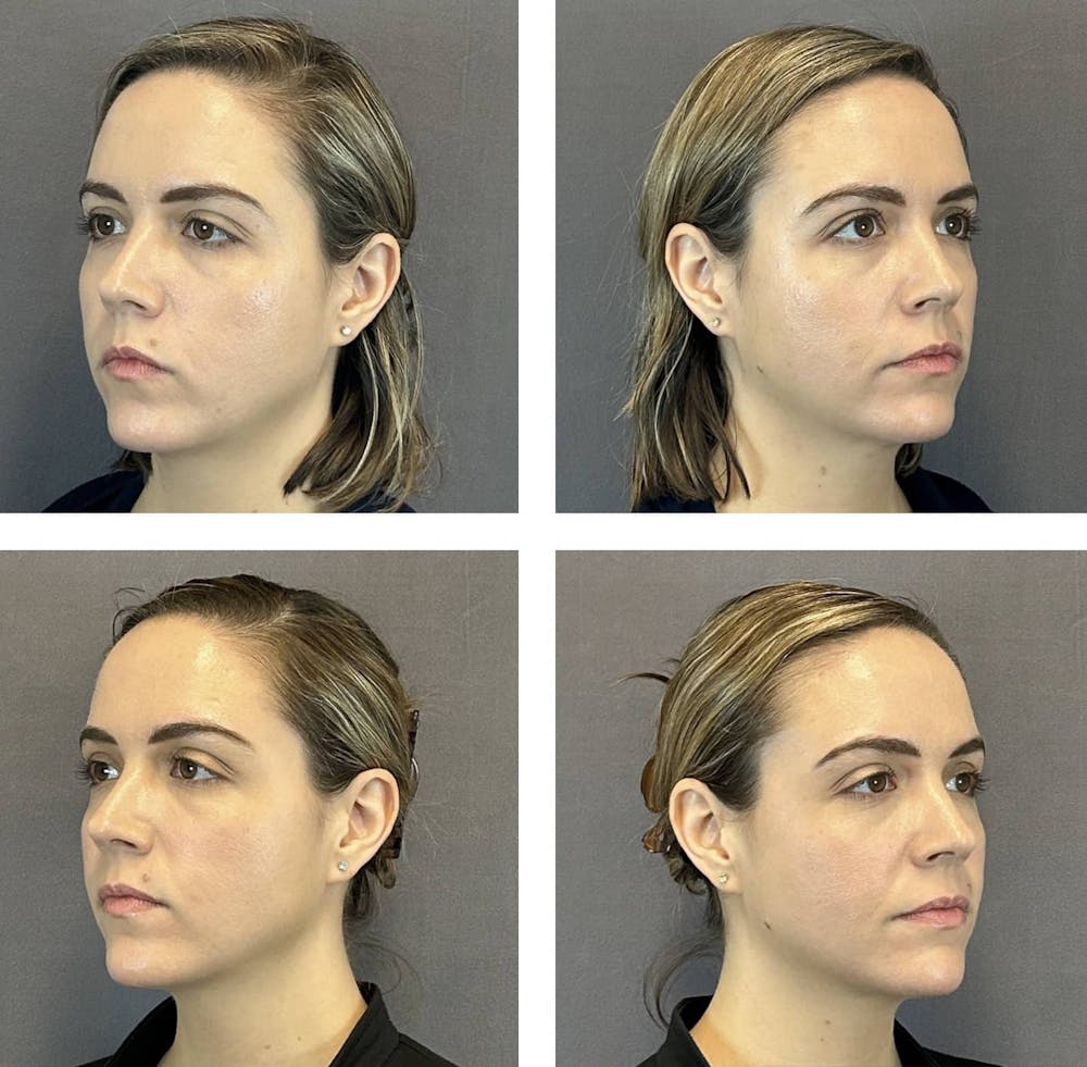 Buccal Fat Reduction Before & After Gallery - Patient 160784301 - Image 1