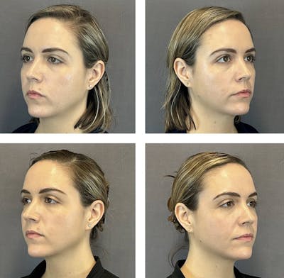 Buccal Fat Reduction Before & After Gallery - Patient 160784301 - Image 1