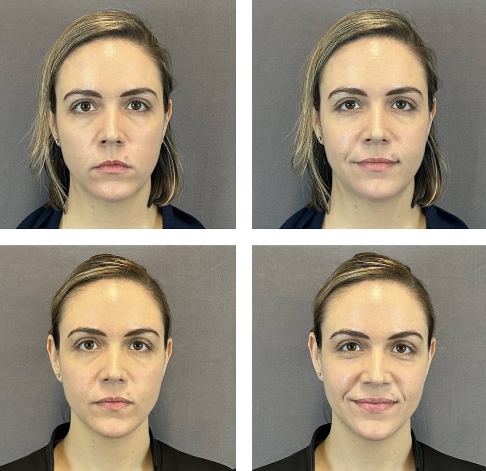 Buccal Fat Reduction Before & After Gallery - Patient 160784301 - Image 2