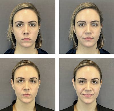 Buccal Fat Reduction Before & After Gallery - Patient 160784301 - Image 2