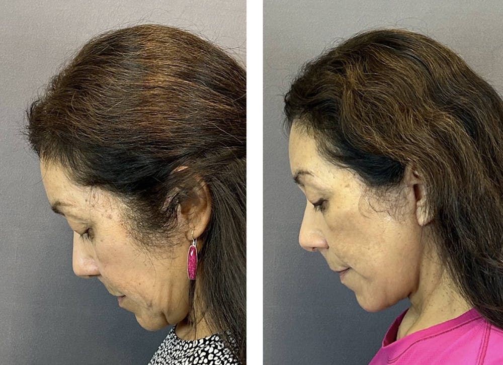 Necklift Before & After Gallery - Patient 160784303 - Image 8