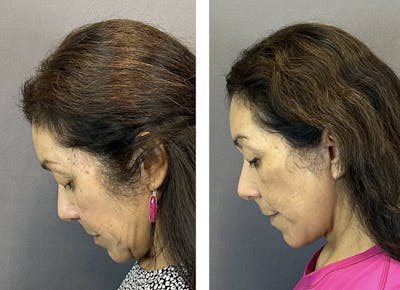 Facelift Before & After Gallery - Patient 160784302 - Image 8