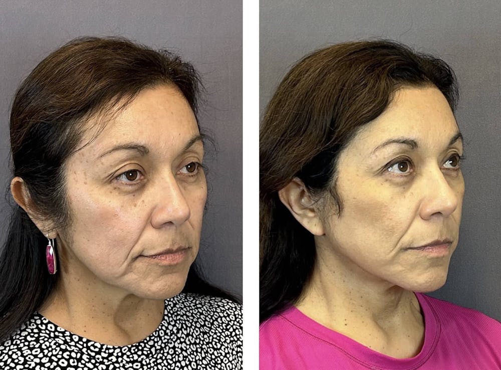 Facelift Before & After Gallery - Patient 160784302 - Image 3
