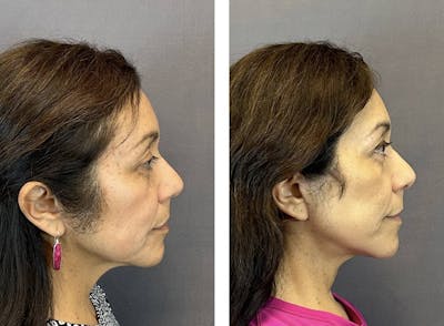 Facelift Before & After Gallery - Patient 160784302 - Image 4