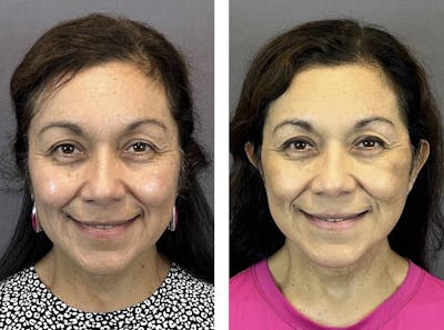 Necklift Before & After Gallery - Patient 160784303 - Image 2
