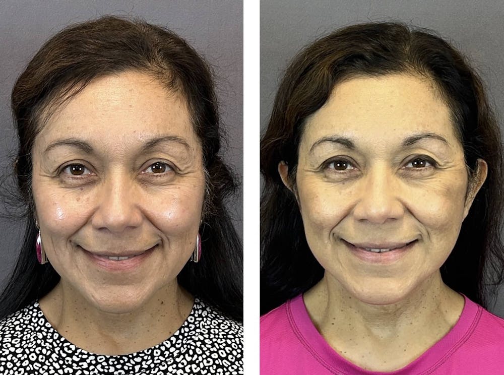 Facelift Before & After Gallery - Patient 160784302 - Image 2