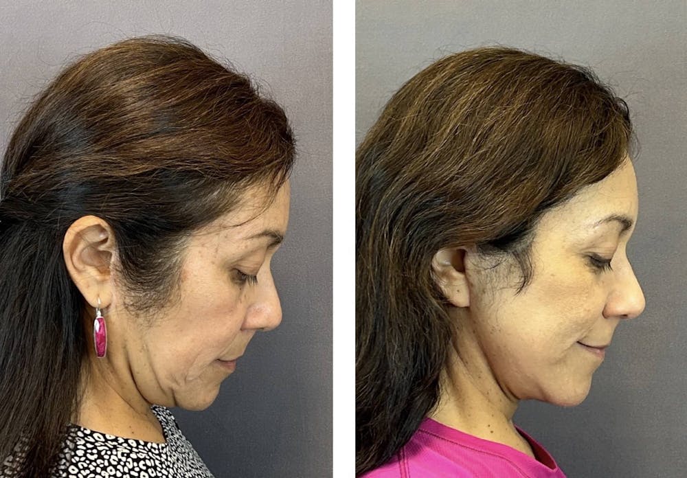Facelift Before & After Gallery - Patient 160784302 - Image 5