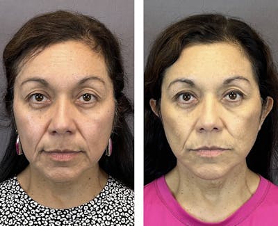 Necklift Before & After Gallery - Patient 160784303 - Image 1