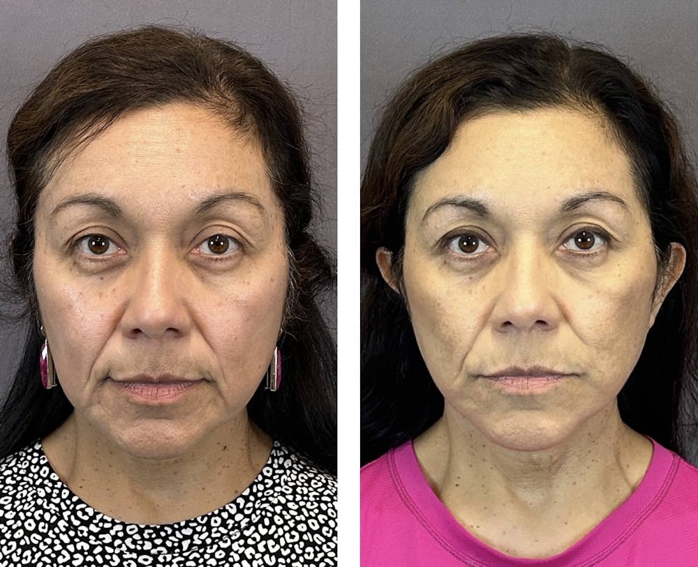 Necklift Before & After Gallery - Patient 160784303 - Image 1