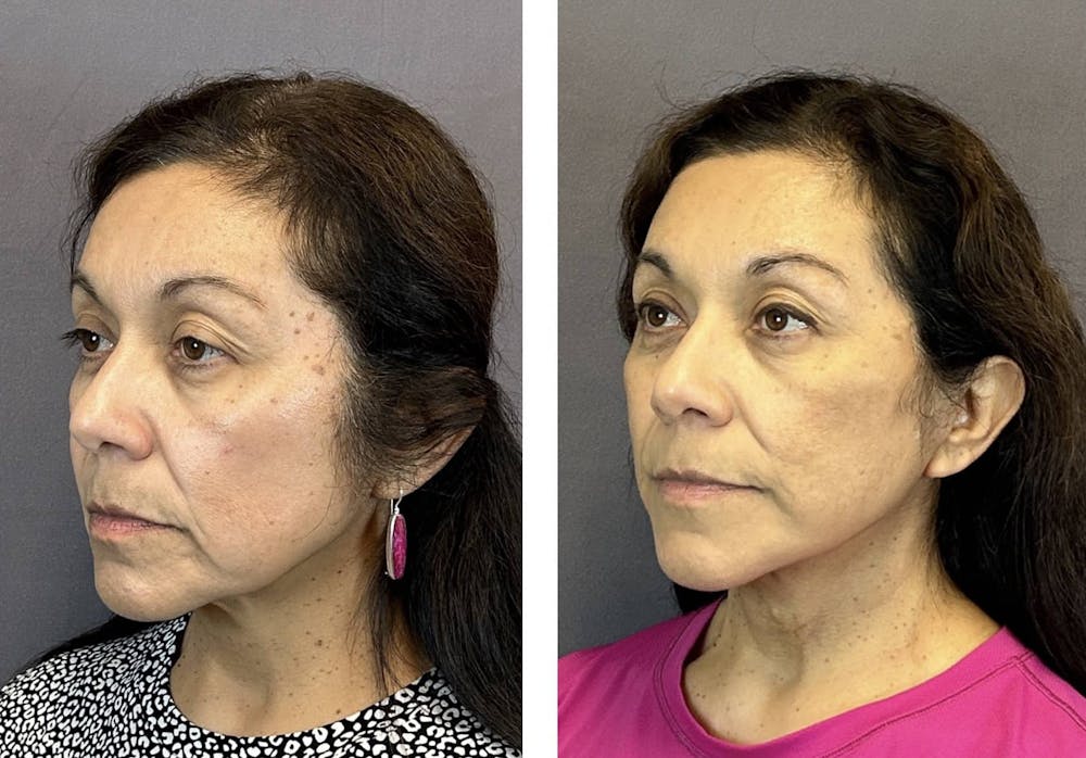 Necklift Before & After Gallery - Patient 160784303 - Image 5
