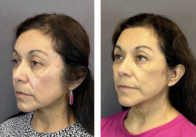 Facelift Before & After Gallery - Patient 160784302 - Image 6