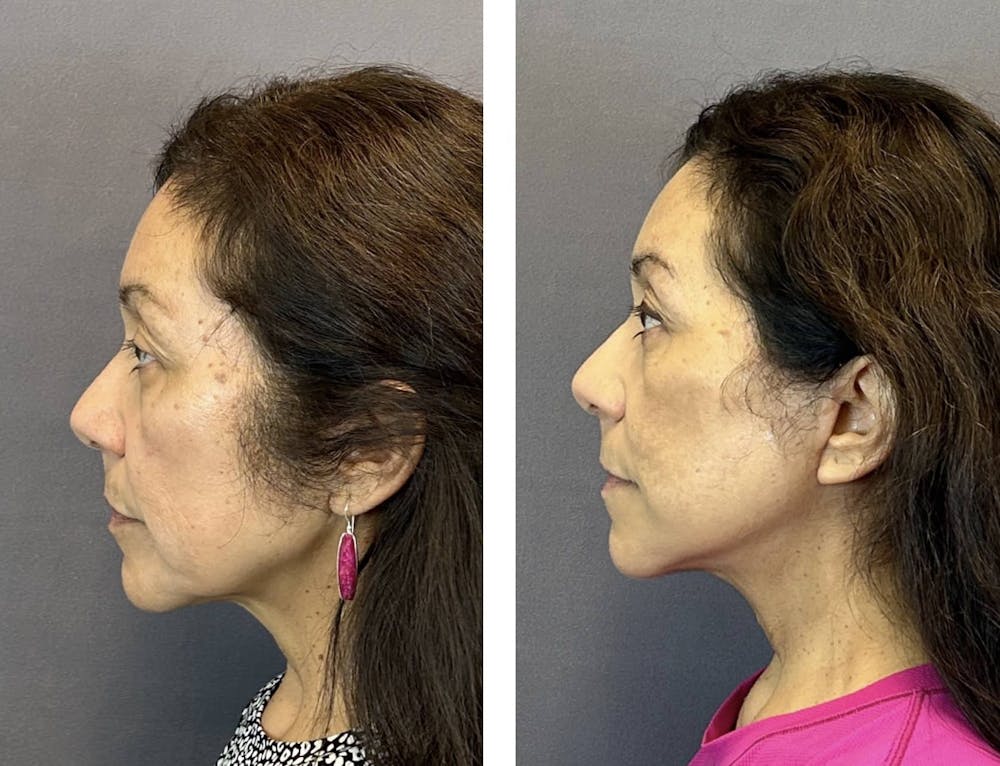 Facelift Before & After Gallery - Patient 160784302 - Image 7