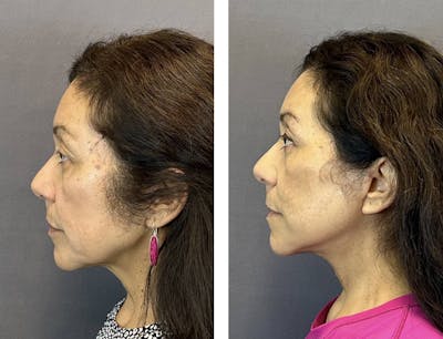 Necklift Before & After Gallery - Patient 160784303 - Image 6