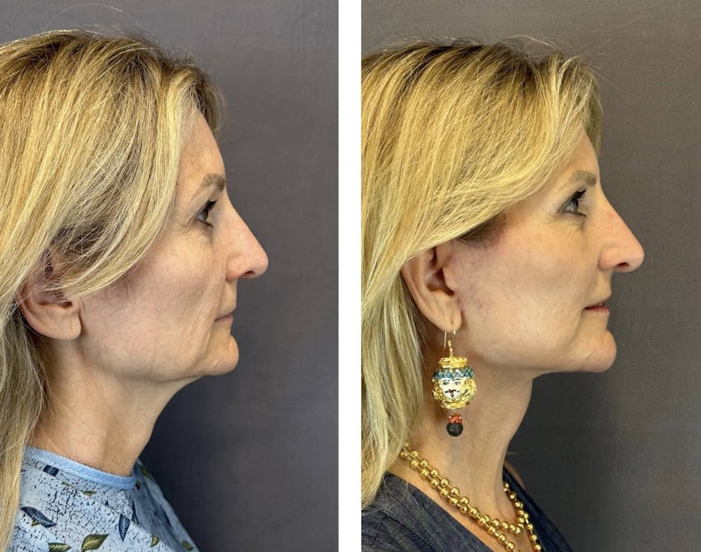 Necklift Before & After Gallery - Patient 160784350 - Image 3