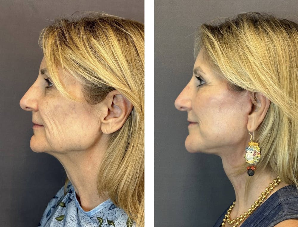 Brow Lift Before & After Gallery - Patient 160784616 - Image 4