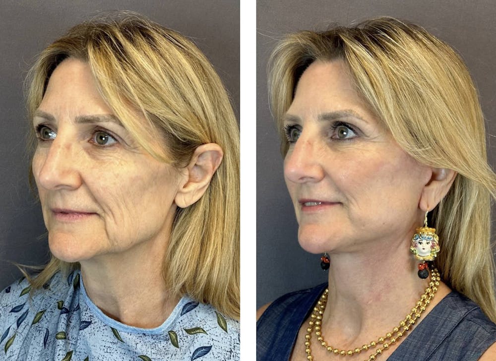 Brow Lift Before & After Gallery - Patient 160784616 - Image 5