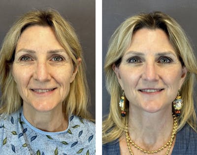 Brow Lift Before & After Gallery - Patient 160784616 - Image 1