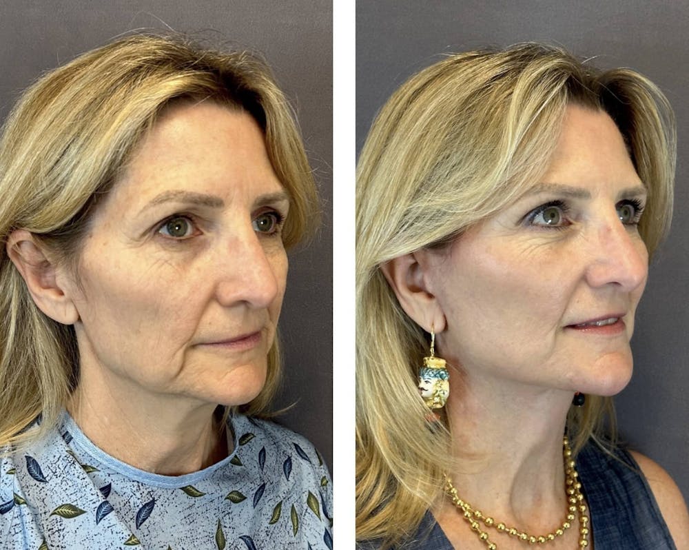 Brow Lift Before & After Gallery - Patient 160784616 - Image 2