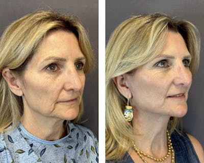 Necklift Before & After Gallery - Patient 160784350 - Image 2