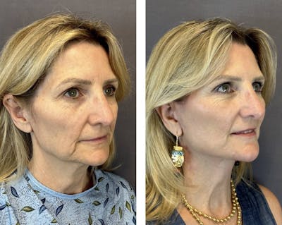 Lower Blepharoplasty Before & After Gallery - Patient 160784719 - Image 2
