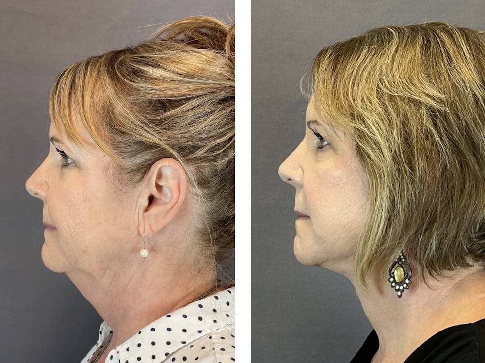 Necklift Before & After Gallery - Patient 160784723 - Image 4