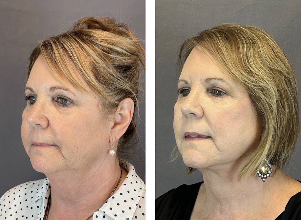 Necklift Before & After Gallery - Patient 160784723 - Image 5