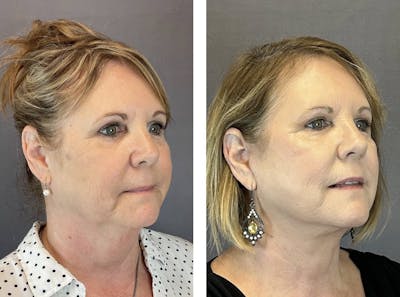 Necklift Before & After Gallery - Patient 160784723 - Image 2