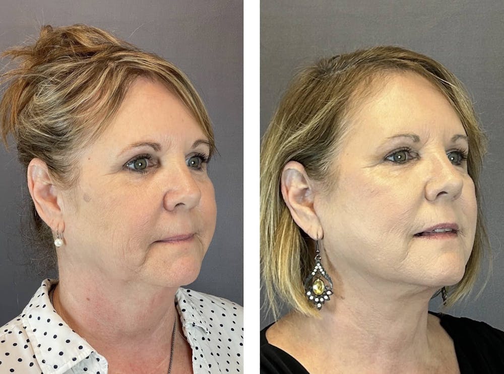 Facelift Before & After Gallery - Patient 160784722 - Image 4