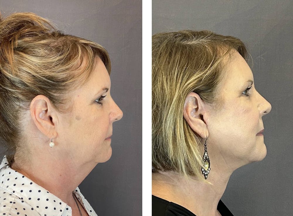 Facelift Before & After Gallery - Patient 160784722 - Image 5