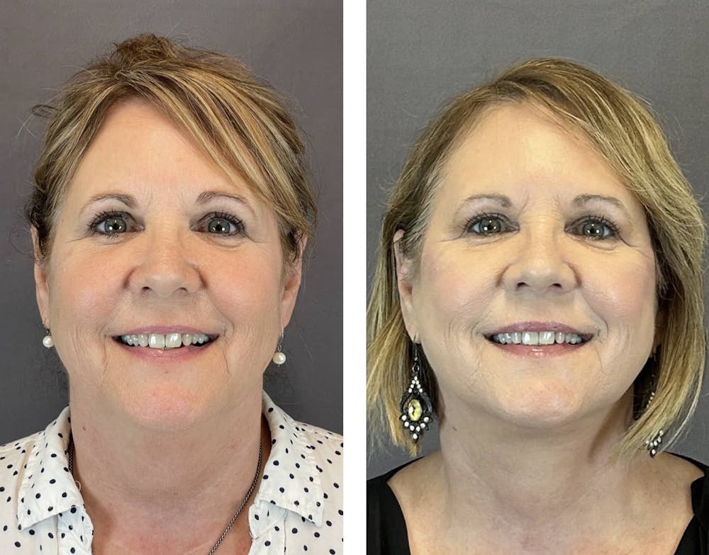 Facelift Before & After Gallery - Patient 160784722 - Image 1