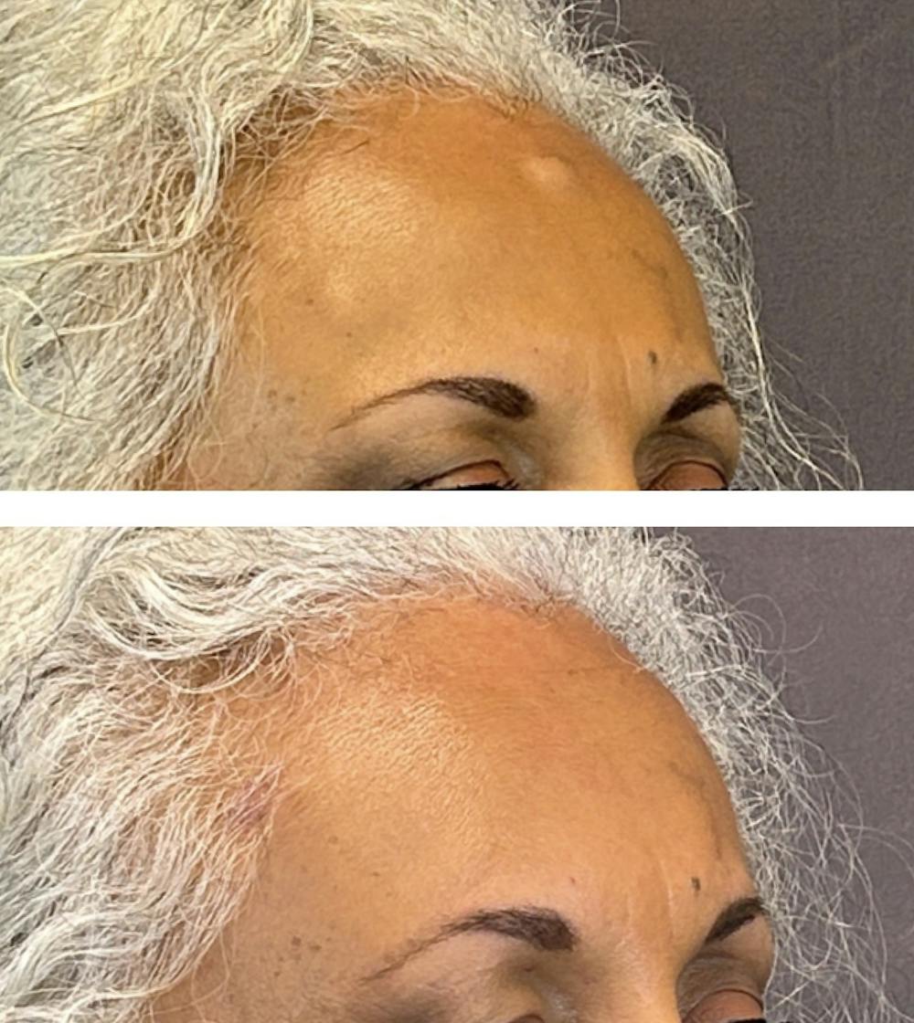 Miscellaneous Facial Procedures Before & After Gallery - Patient 160785646 - Image 2