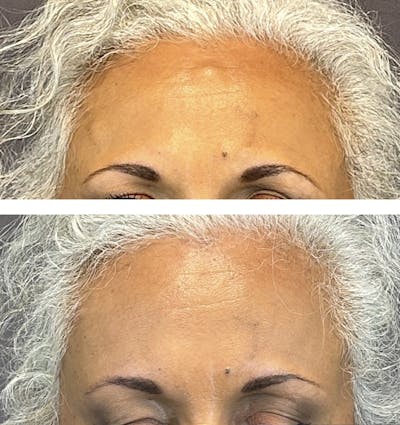 Miscellaneous Facial Procedures Before & After Gallery - Patient 160785646 - Image 1