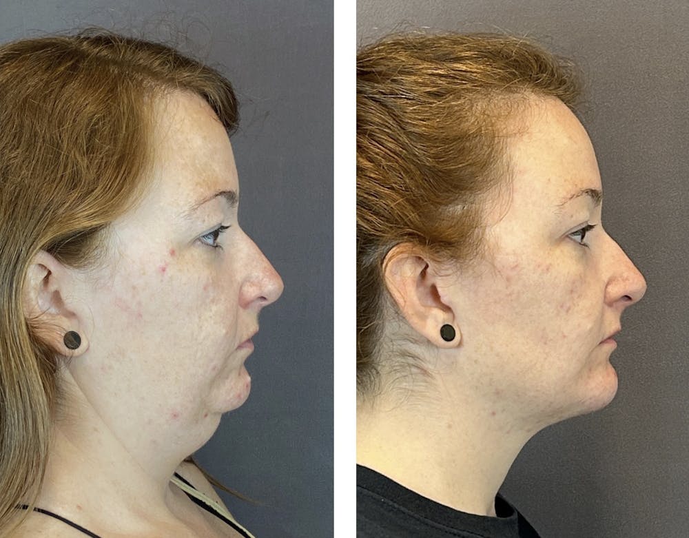 Necklift Before & After Gallery - Patient 160918502 - Image 2