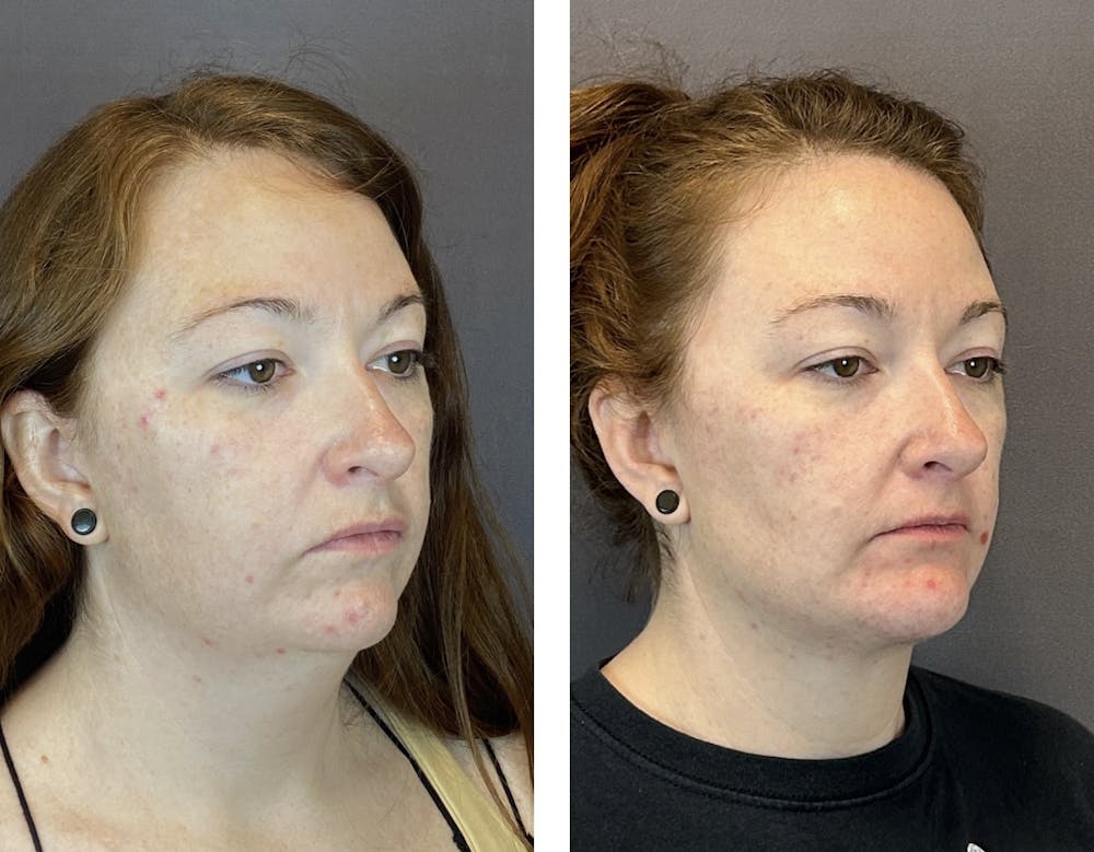Necklift Before & After Gallery - Patient 160918502 - Image 3