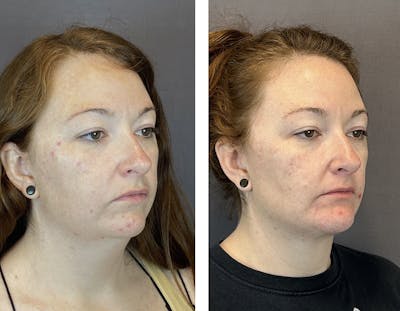 Chin Implant Before & After Gallery - Patient 160918288 - Image 2
