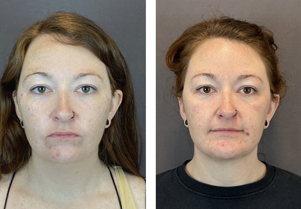 Buccal Fat Reduction Before & After Gallery - Patient 160918420 - Image 3