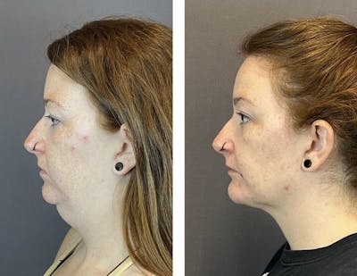 Necklift Before & After Gallery - Patient 160918502 - Image 4