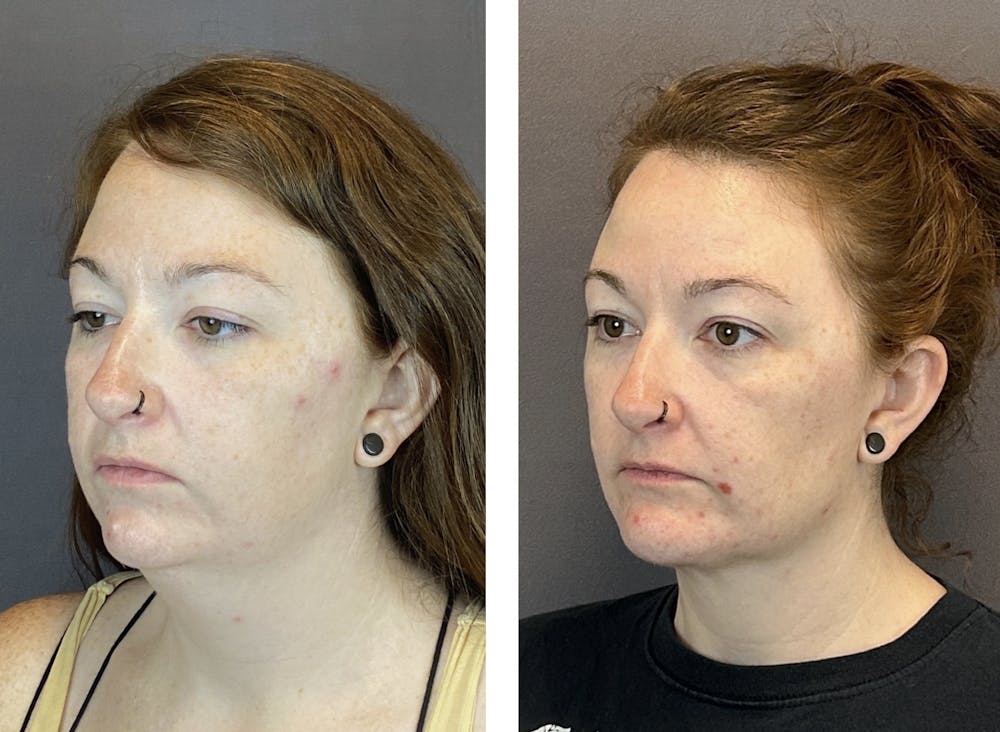 Buccal Fat Reduction Before & After Gallery - Patient 160918420 - Image 5