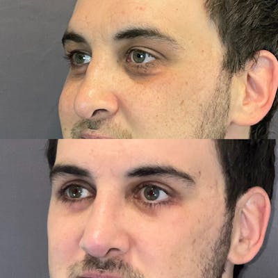 Upper Blepharoplasty Before & After Gallery - Patient 164609855 - Image 2
