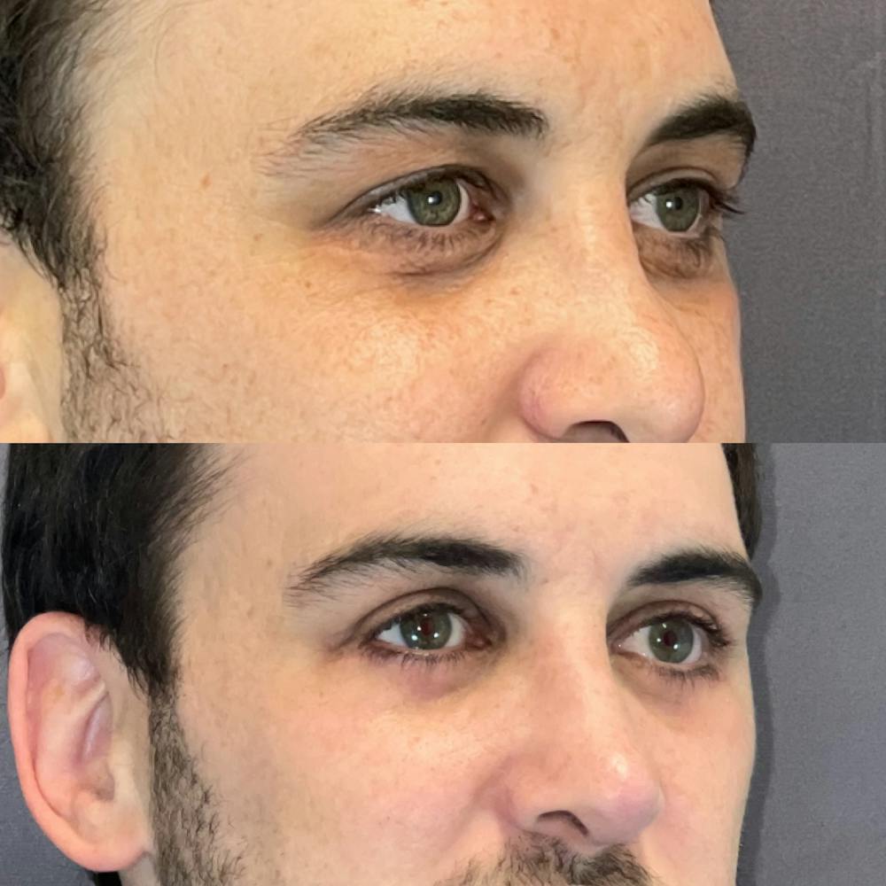 Upper Blepharoplasty Before & After Gallery - Patient 164609855 - Image 3