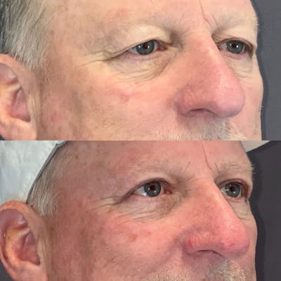 Upper Blepharoplasty Before & After Gallery - Patient 164610969 - Image 2