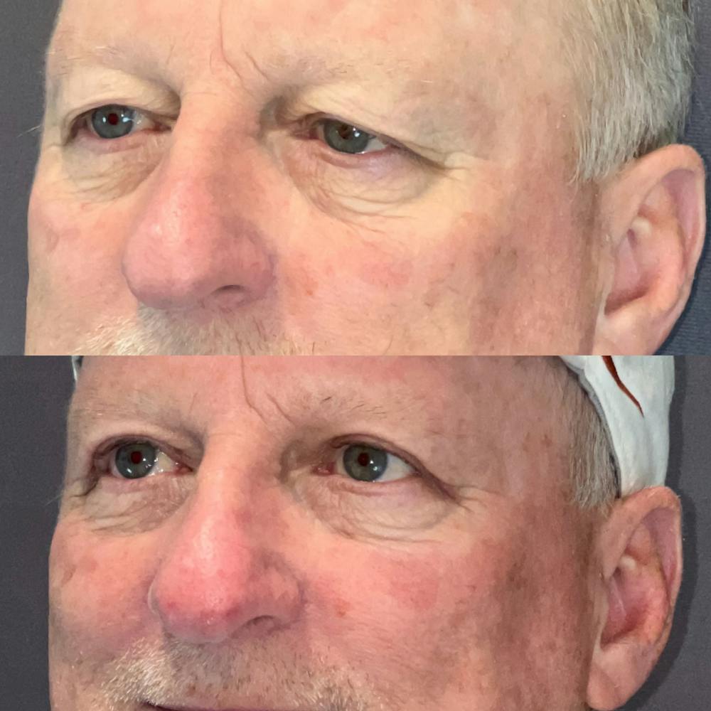 Upper Blepharoplasty Before & After Gallery - Patient 164610969 - Image 3