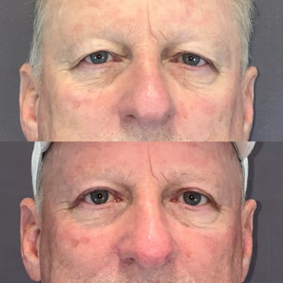 Upper Blepharoplasty Before & After Gallery - Patient 164610969 - Image 1