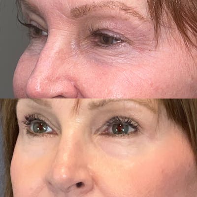 Brow Lift Before & After Gallery - Patient 166803373 - Image 2